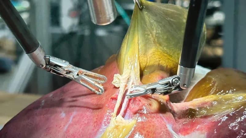 Həkimlərə pis xəbər: Bir robot insan kimi əməliyyat etməyi bacardı