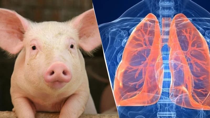 Alimlər ilk dəfə donuzdan insana ağciyər köçürdü
