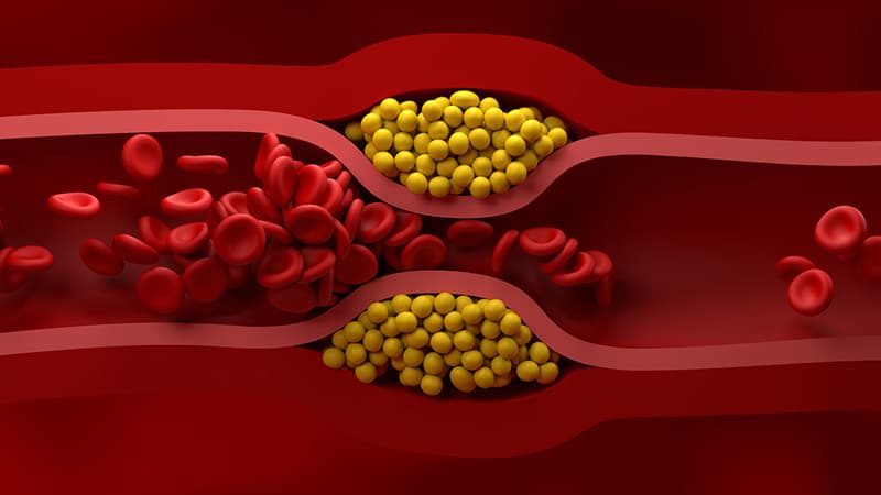 Kardioloqlar xolesterin səviyyəsinə nəzarətlə bağlı tövsiyələri köklü şəkildə yenilədi