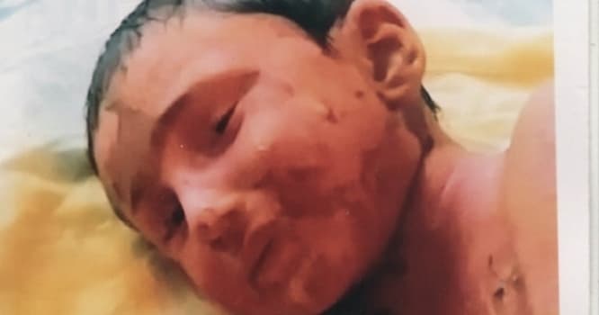 Yevlaxda həkimlərin yanlış müalicəsi uşağı dəhşətli vəziyyətə salıb - VİDEO