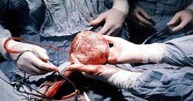 Ölkəmizdə yenilik - Ürək transplantasiyası mümkün olacaq