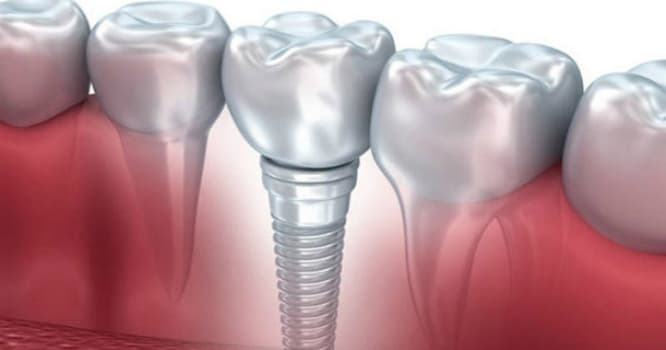 Diş implantı xərçəng yaradır?