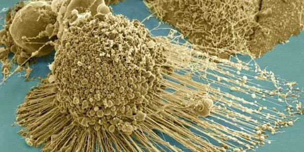 Xərçəng xəstəliyinə son: müalicəsi tapıldı