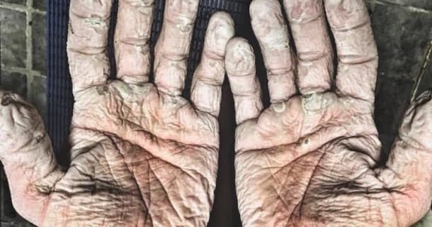 11 dünya rekordu qırdı, amma əlləri bu vəziyyətə düşdü (FOTO)