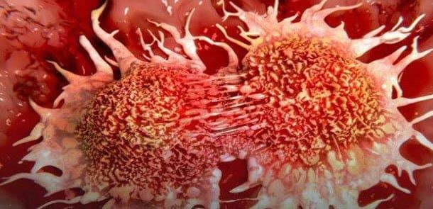 Məşhur onkoloq xərçəngin 5 səbəbini açıqladı