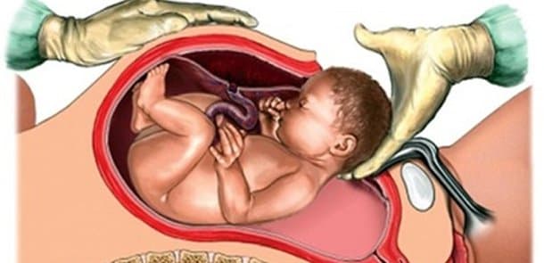 Qeysəriyyə əməliyyatı ilə dünyaya gələn körpələr haqqında söylənilən 5 gerçək