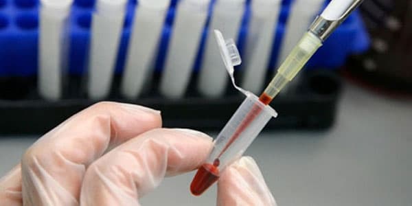 Həkim-infeksionist: "QİÇS-li qız dedi ki, gələn həftə toyumdur"