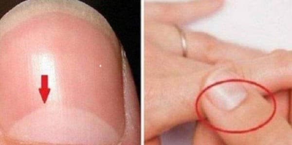Dırnaqlarınızdakı ağ ləkələr hansı xəstəliklərdən xəbər verir? (SİYAHI)