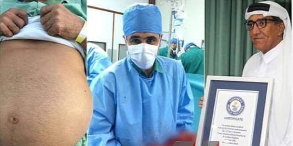 Azərbaycanlı böyrək xəstəsi “Ginnesin rekordlar kitabı”na namizəddir (FOTO/VİDEO)