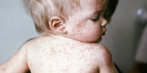 Həkimlərdən valideynlərə ciddi xəbərdarlıq: bu epidemiya sürətlə yayılır (VİDEO)