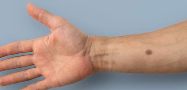 Xərçəngi əvvəlcədən müəyyən edə biləcək dəri implantı yaradıldı