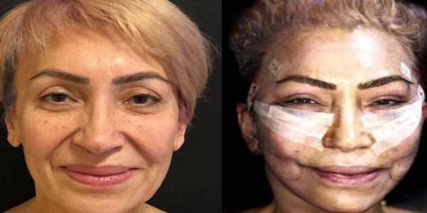Əməkdar artistin əməliyyat görüntüsü yayıldı (VİDEO)