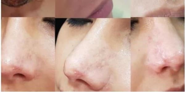 Azərbaycanda kosmetoloq qızın burnunu çürütdü (FOTOLAR)