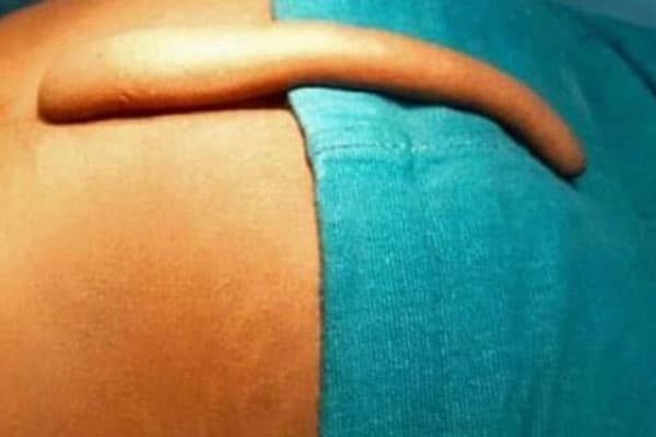 Azərbaycanda 17 yaşlı oğlanda 18 sm uzunluğunda quyruq aşkarlandı (FOTO)