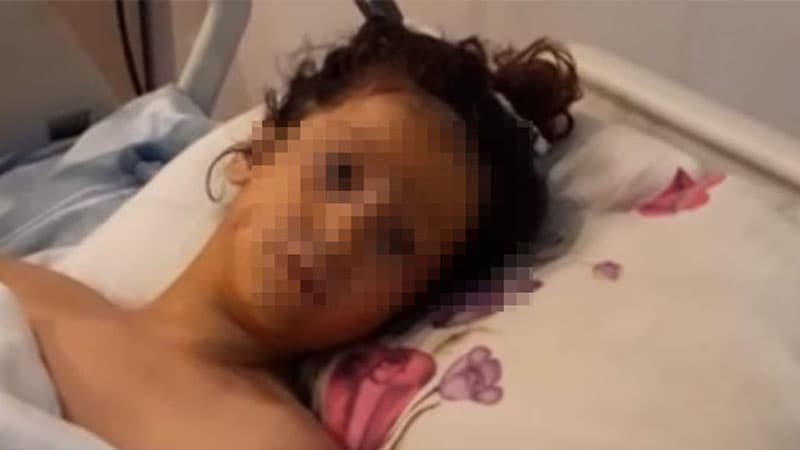 Transformatora girən azyaşlının 2 ayağı və qolu amputasiya edildi