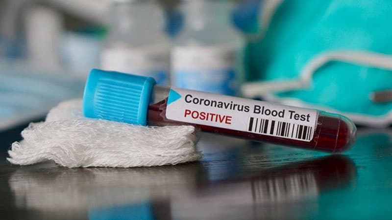 Azərbaycanda koronavirusla bağlı bu günə olan statistika