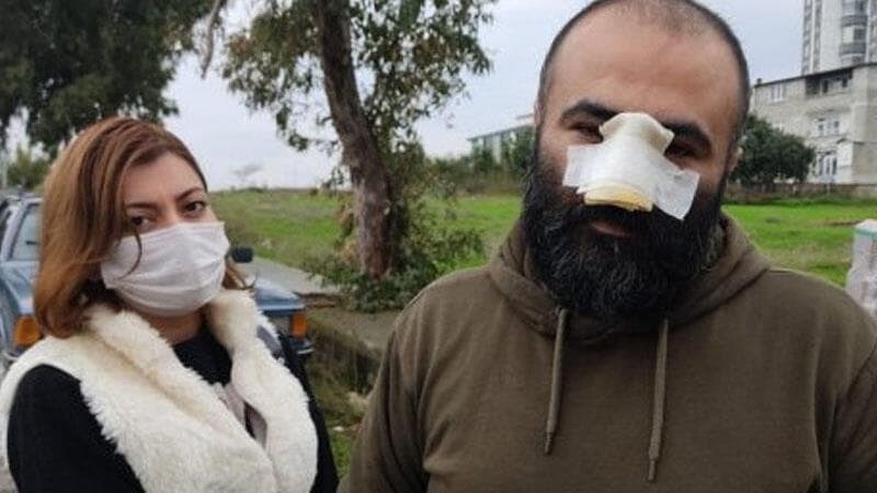 Pitbul azərbaycanlı iş adamının burnunu qopardı